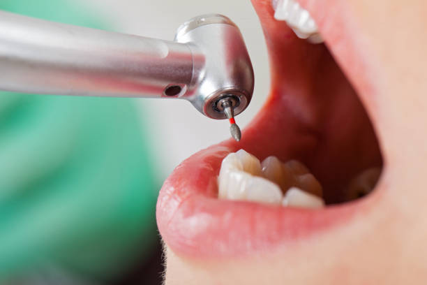 Best Lost Filling or Crown Replacement in Union Beach, NJ